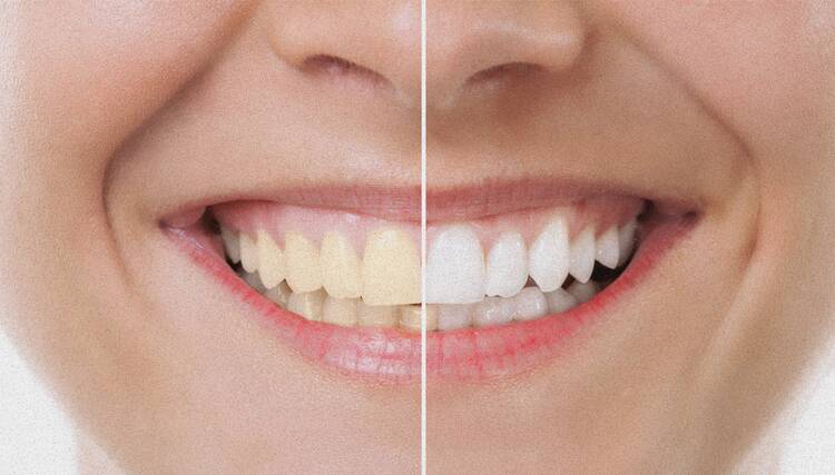 Bleaching - Für Ihr strahlendstes Lächeln durch eine schonende Zahnaufhellung